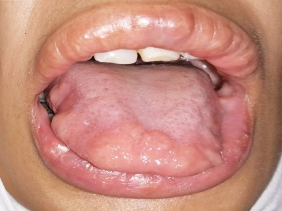 Multiple hypertrophied tongue lesions in MEN2